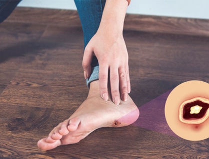 Bạn cần biết gì về biến chứng bàn chân do đái tháo đường?