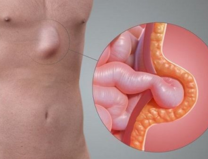 Làm thế nào để tự đánh giá nguy cơ mắc thoát vị?