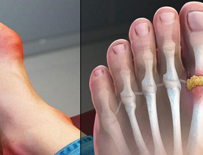 Bệnh gout cấp có chữa khỏi được không?
