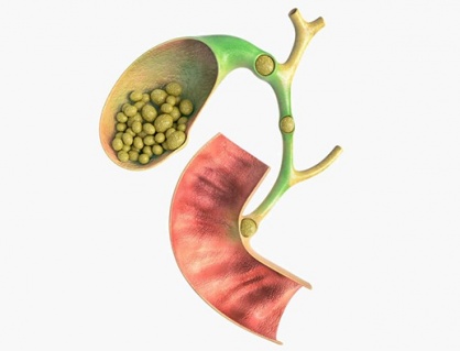 Sỏi ống mật chủ sau phẫu thuật có nguy hiểm không?