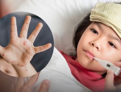 Bệnh thủy đậu là gì và cách điều trị ra sao? 