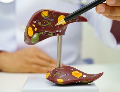 Tổng quan về sỏi đường mật trong gan: Những điều bạn cần biết