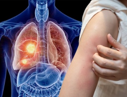 Dấu hiệu ngoài da cảnh báo u phổi