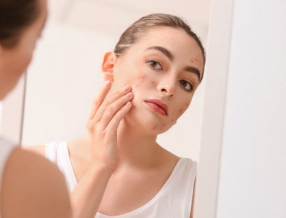 Infographic: Tại sao người trưởng thành vẫn có thể bị mụn?