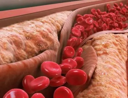 Xơ vữa động mạch hình thành như thế nào?  