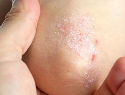 Cây sói rừng - thảo dược hỗ trợ cải thiện bệnh vảy nến hiệu quả