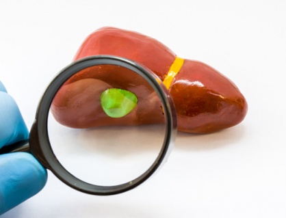 Polyp túi mật có nguy hiểm không?