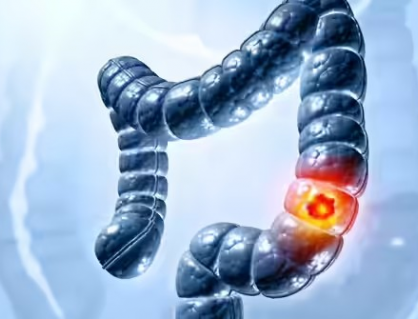 5 dấu hiệu ung thư đại tràng phổ biến dễ bị bỏ qua