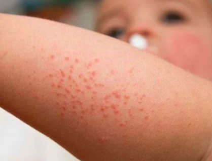 Bệnh sởi và nguy cơ suy giảm miễn dịch