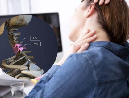 Thoát vị đĩa đệm C5-C6 phải làm sao?