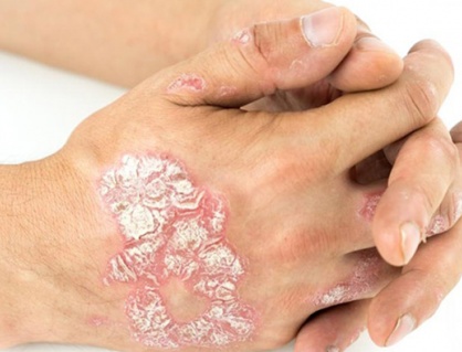 Bị vảy nến thể mảng cần lưu ý những gì?