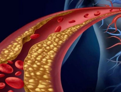 Rối loạn lipid máu có chữa khỏi được không?