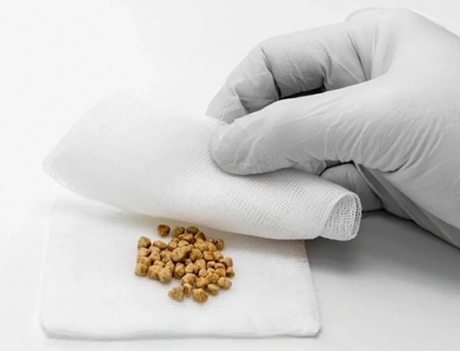 Vì sao sỏi mật 11mm kèm mỡ máu cao lại gây đầy hơi, khó tiêu?