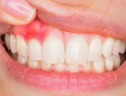 Mách bạn 5 cách cải thiện viêm lợi tại nhà