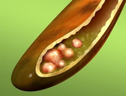 Sỏi bùn túi mật 7mm kèm đái tháo đường: Dùng TPBVSK Kim Đởm Khang được không?