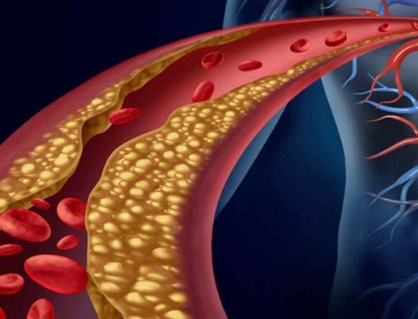 Rối loạn lipid máu: Nhận diện nguy cơ và giải pháp kiểm soát an toàn