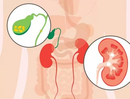 Sỏi mật có gây ra các vấn đề về đường tiết niệu không?