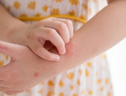 Giải pháp thảo dược cho trẻ bị nổi mề đay