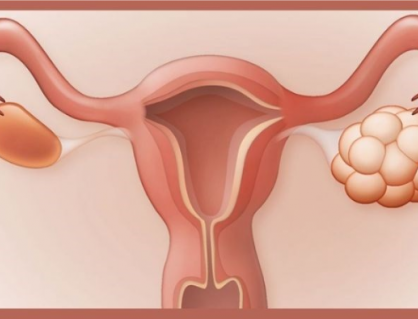 Hội chứng buồng trứng đa nang có tên gọi mới sau hơn 90 năm