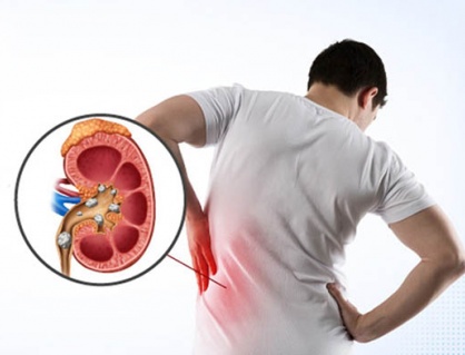 Chế độ ăn uống giúp ngăn sỏi thận tái phát