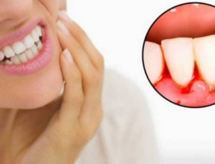 Chảy máu chân răng cảnh báo bệnh gì?