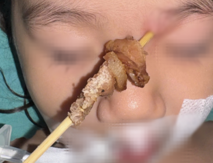 Bé gái 2 tuổi suýt mù mắt, tổn thương não khi ăn thịt xiên nướng