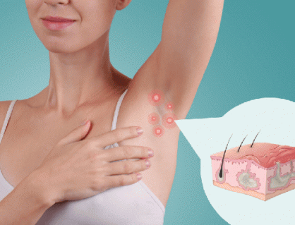 Sống chung với viêm tuyến mồ hôi mủ trong mùa Hè