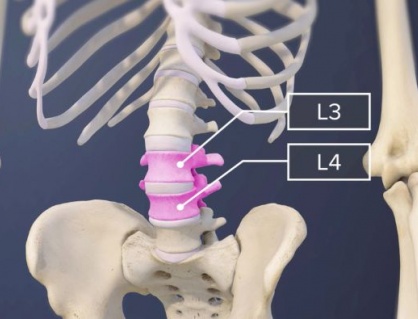 Dấu hiệu nhận biết thoát vị đĩa đệm L3 L4