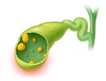 Polyp túi mật 14mm có nguy hiểm không?
