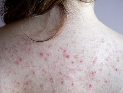 Bị mụn lưng phải làm sao?