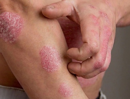 Bị vảy nến có chữa được không?