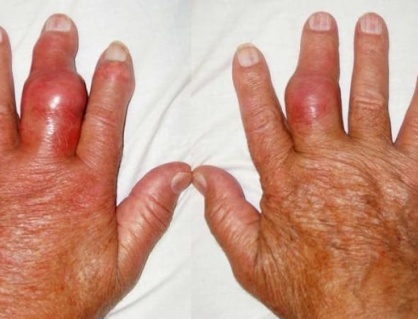 Hạt tophi xuất hiện ở người bệnh gout: Cảnh báo không nên chủ quan