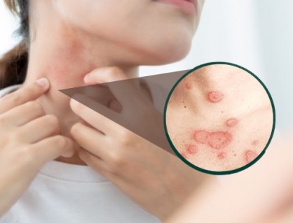 Lupus ban đỏ dạng đĩa có nguy hiểm không? 