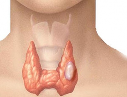 Bướu cổ đơn thuần có nguy hiểm không?
