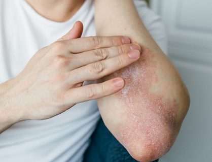 Nguyên nhân nào khiến vảy nến lan ra toàn thân?