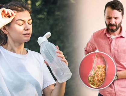 Uống ít nước có làm tăng nguy cơ bị sỏi mật không?
