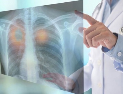 Dấu hiệu nhận biết u phổi lành tính và ác tính
