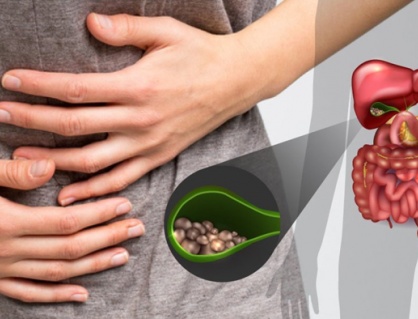 Sỏi mật gây đau bụng, đầy trướng và chậm tiêu xử trí thế nào?