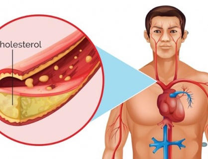 Bảo vệ trái tim trước mối nguy do tăng cholesterol