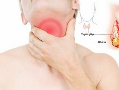 Có những loại bướu tuyến giáp nào?