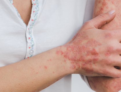 Những hiểu lầm khiến người bệnh vảy nến thêm tự ti