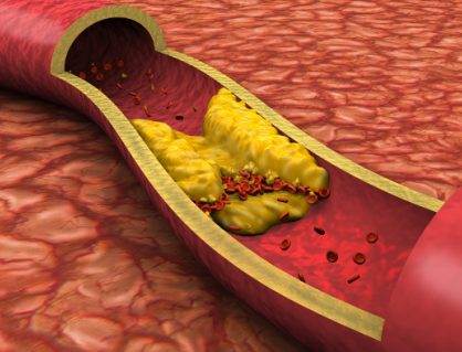 Cholesterol cao và xơ vữa động mạch: Mối liên hệ nhiều người còn chủ quan