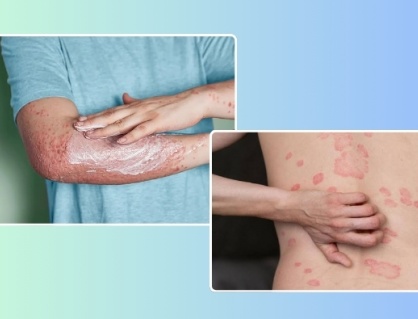 Mẹo chăm sóc da cho người bệnh vảy nến thể mảng