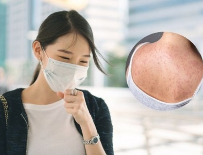 Người lớn cũng bị sởi: Bà bầu cần lưu ý gì?