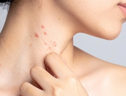 Hướng đi mới giúp kiểm soát bệnh lupus ban đỏ từ thảo dược tự nhiên