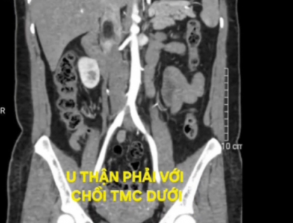 Tình cờ phát hiện u thận kèm huyết khối tĩnh mạch chủ