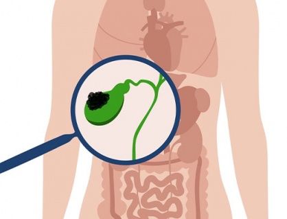 Đa polyp túi mật 9x8mm nên xử trí thế nào?