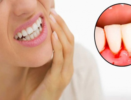 Bị viêm quanh răng có nguy hiểm không?