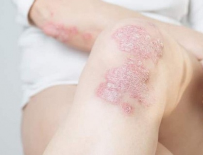 Chủ động kiểm soát vảy nến từ sớm để không lo bệnh bùng phát khi trời lạnh