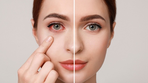 Sai lầm cần tránh khi bị đau mắt đỏ